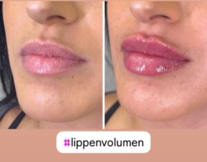 Hyaluron - Lippenvolumen