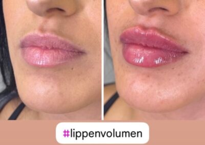 Hyaluron - Lippenvolumen